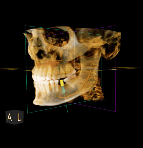 Cone Beam ou CBCT