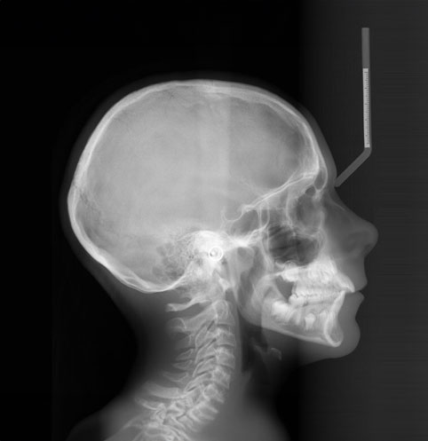 Téléradiographie de profil & de face